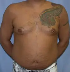 Liposuction Before and After Pictures in Middletown and Red Bank, NJ