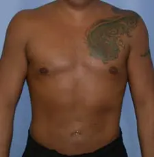 Liposuction Before and After Pictures in Middletown and Red Bank, NJ