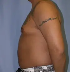 Liposuction Before and After Pictures in Middletown and Red Bank, NJ