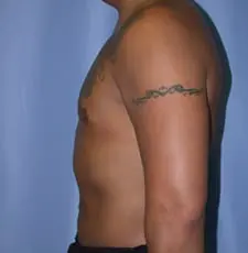 Liposuction Before and After Pictures in Middletown and Red Bank, NJ
