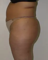Liposuction Before and After Pictures in Middletown and Red Bank, NJ