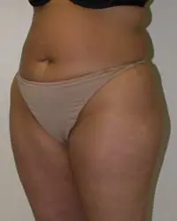 Liposuction Before and After Pictures in Middletown and Red Bank, NJ