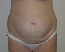 Tummy Tuck Before and After Pictures in Middletown and Red Bank, NJ