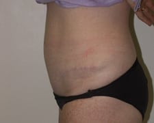 Tummy Tuck Before and After Pictures in Middletown and Red Bank, NJ