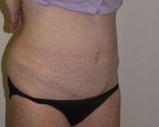 Tummy Tuck Before and After Pictures in Middletown and Red Bank, NJ