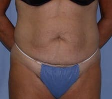 Tummy Tuck Before and After Pictures in Middletown and Red Bank, NJ