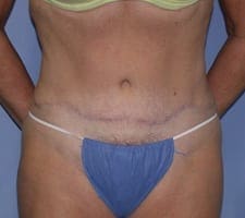 Tummy Tuck Before and After Pictures in Middletown and Red Bank, NJ