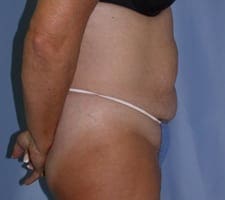 Tummy Tuck Before and After Pictures in Middletown and Red Bank, NJ