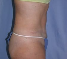 Tummy Tuck Before and After Pictures in Middletown and Red Bank, NJ