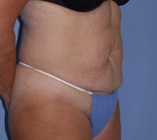 Tummy Tuck Before and After Pictures in Middletown and Red Bank, NJ