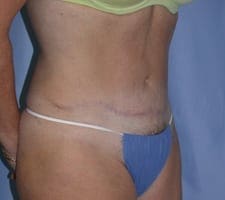 Tummy Tuck Before and After Pictures in Middletown and Red Bank, NJ