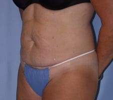 Tummy Tuck Before and After Pictures in Middletown and Red Bank, NJ