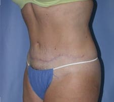 Tummy Tuck Before and After Pictures in Middletown and Red Bank, NJ