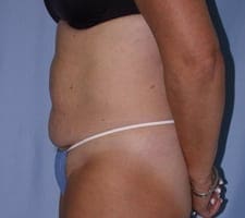 Tummy Tuck Before and After Pictures in Middletown and Red Bank, NJ