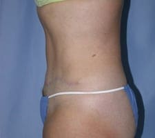 Tummy Tuck Before and After Pictures in Middletown and Red Bank, NJ