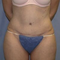 Tummy Tuck Before and After Pictures in Middletown and Red Bank, NJ