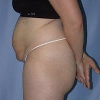 Tummy Tuck Before and After Pictures in Middletown and Red Bank, NJ