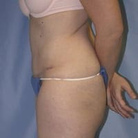 Tummy Tuck Before and After Pictures in Middletown and Red Bank, NJ