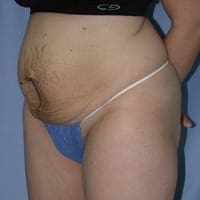 Tummy Tuck Before and After Pictures in Middletown and Red Bank, NJ