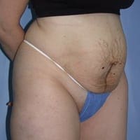 Tummy Tuck Before and After Pictures in Middletown and Red Bank, NJ