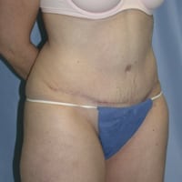 Tummy Tuck Before and After Pictures in Middletown and Red Bank, NJ