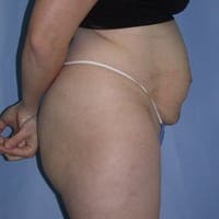 Tummy Tuck Before and After Pictures in Middletown and Red Bank, NJ