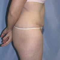 Tummy Tuck Before and After Pictures in Middletown and Red Bank, NJ