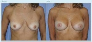 Breast Augmentation in Middletown, NJ