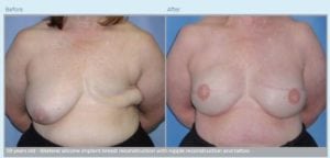 Breast Reconstruction in Middletown, NJ