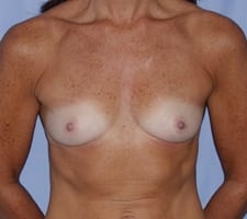 Breast Augmentation Before and After Pictures in Middletown and Red Bank, NJ