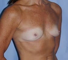 Breast Augmentation Before and After Pictures in Middletown and Red Bank, NJ