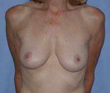 Breast Augmentation Before and After Pictures in Middletown and Red Bank, NJ
