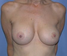 Breast Augmentation Before and After Pictures in Middletown and Red Bank, NJ