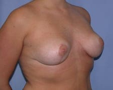 Breast Lift Before and After Pictures in Middletown and Red Bank, NJ