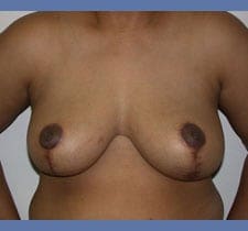 Breast Reduction Before and After Pictures in Middletown and Red Bank, NJ