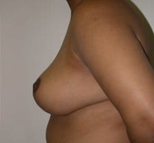 Breast Reduction Before and After Pictures in Middletown and Red Bank, NJ