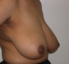 Breast Reduction Before and After Pictures in Middletown and Red Bank, NJ