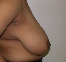 Breast Reduction Before and After Pictures in Middletown and Red Bank, NJ