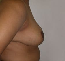 Breast Reduction Before and After Pictures in Middletown and Red Bank, NJ