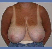 Breast Reduction Before and After Pictures in Middletown and Red Bank, NJ