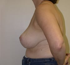 Breast Reduction Before and After Pictures in Middletown and Red Bank, NJ