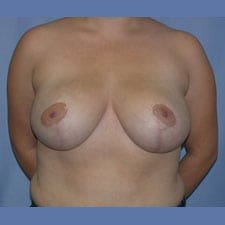 Breast Reduction Before and After Pictures in Middletown and Red Bank, NJ