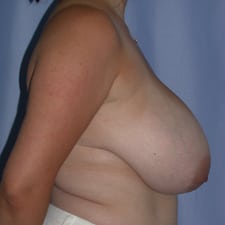 Breast Reduction Before and After Pictures in Middletown and Red Bank, NJ