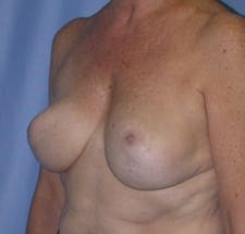 Breast Reduction Before and After Pictures in Middletown and Red Bank, NJ