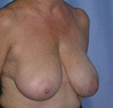 Breast Reduction Before and After Pictures in Middletown and Red Bank, NJ