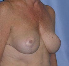 Breast Reduction Before and After Pictures in Middletown and Red Bank, NJ