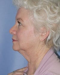 Facelift Before and After Pictures in Middletown and Red Bank, NJ