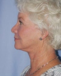 Facelift Before and After Pictures in Middletown and Red Bank, NJ