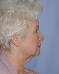 Facelift Before and After Pictures in Middletown and Red Bank, NJ