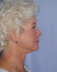 Facelift Before and After Pictures in Middletown and Red Bank, NJ